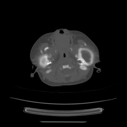 Cloverleaf skull (Radiopaedia 91901-109710 Axial bone window 38).jpg
