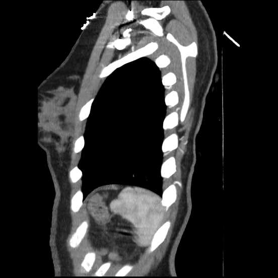 Coarctation of the aorta (Radiopaedia 67609-77010 C 9).jpg