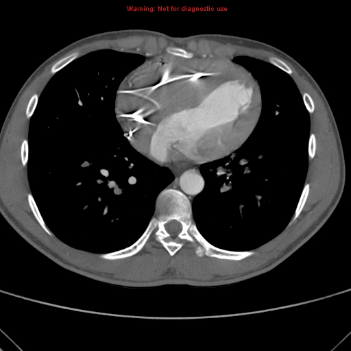 File:Coarctation of the aorta (Radiopaedia 9434-10118 A 126).jpg