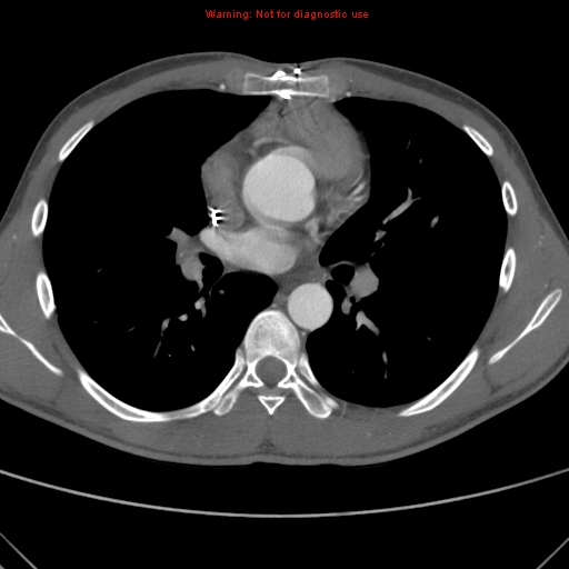 File:Coarctation of the aorta (Radiopaedia 9434-10118 A 94).jpg