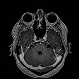 Cochlear incomplete partition type III associated with hypothalamic hamartoma (Radiopaedia 88756-105498 Axial T1 C+ 69).jpg
