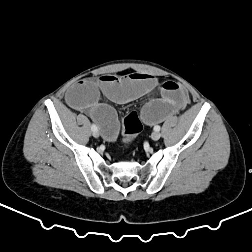 Colocolic intussusception due to large lipoma (Radiopaedia 68773-78482 A 153).jpg