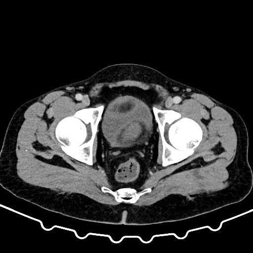 File:Colocolic intussusception due to large lipoma (Radiopaedia 68773-78482 A 180).jpg