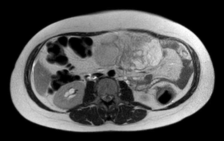 File:Colon adenocarcinoma with Krukenberg tumors, advanced pregnancy (Radiopaedia 67279-76645 Axial T2 45).jpg