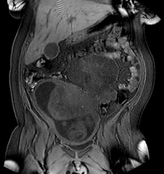 Colon adenocarcinoma with Krukenberg tumors, advanced pregnancy (Radiopaedia 67279-76645 E 32).jpg