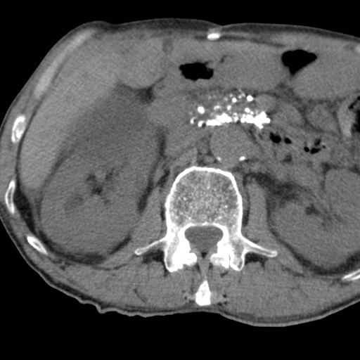Colon cancer with calcified liver metastasis (Radiopaedia 74423-85309 Axial non-contrast 38).jpg