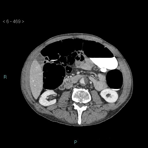 File:Colonic cancer (ultrasound and TC imaging) (Radiopaedia 50346-55713 A 53).jpg