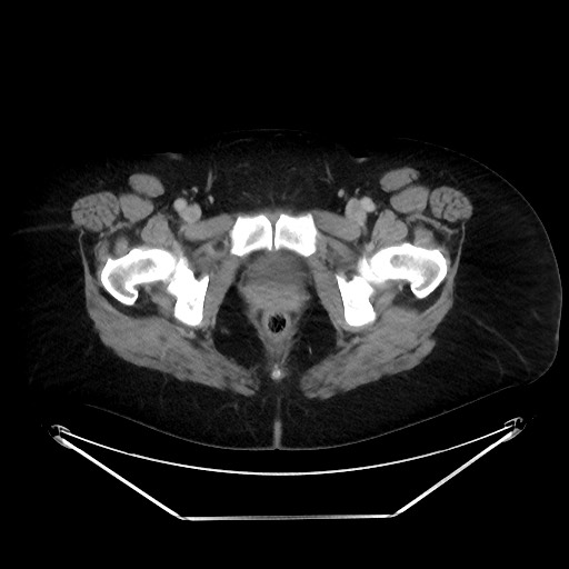 File:Colonic intussusception due to adenocarcinoma (Radiopaedia 86828-102987 Axial 124).jpg