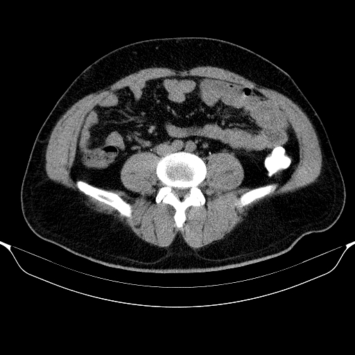 Colonic lipoma with colo-colic intussusception (Radiopaedia 58944-66200 Axial C+ rectal 41).jpg