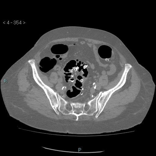 Colonic lipomas (Radiopaedia 49137-54244 Axial bone window 158).jpg
