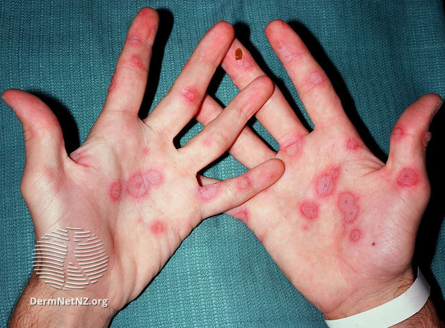 File:Cutaneous adverse reaction to anticonvulsant, erythema multiforme target lesions (DermNet NZ reactions-ac-em).jpg