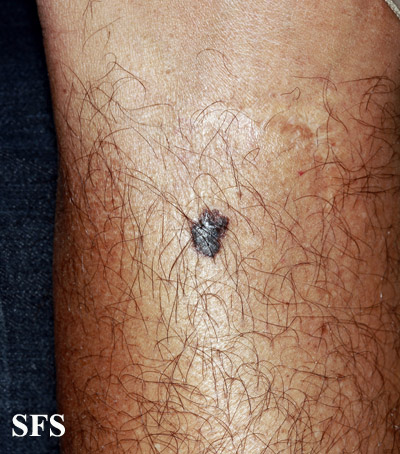 File:Melanoma (Dermatology Atlas 78).jpg
