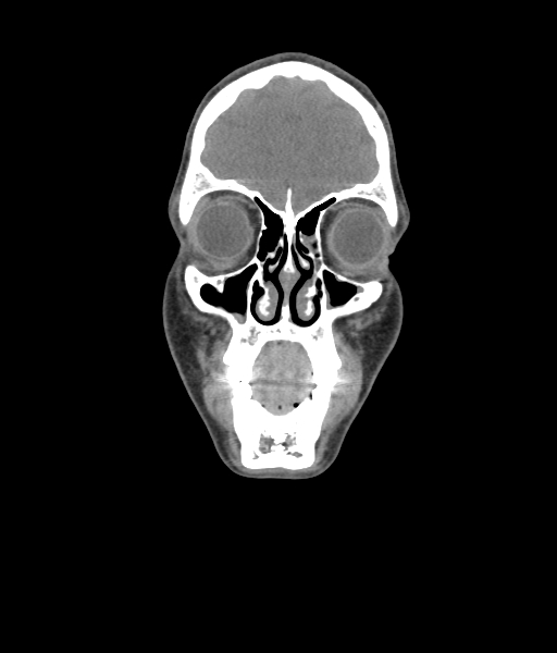 Nasal pyogenic granuloma (lobular capillary hemangioma) (Radiopaedia 85536-101244 Coronal non-contrast 63).jpg
