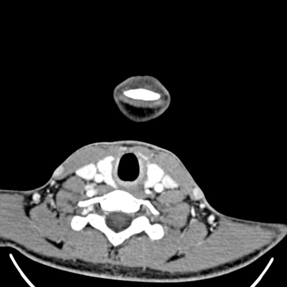 Nasopharyngeal carcinoma with skull base invasion (Radiopaedia 53415-59705 A 167).jpg