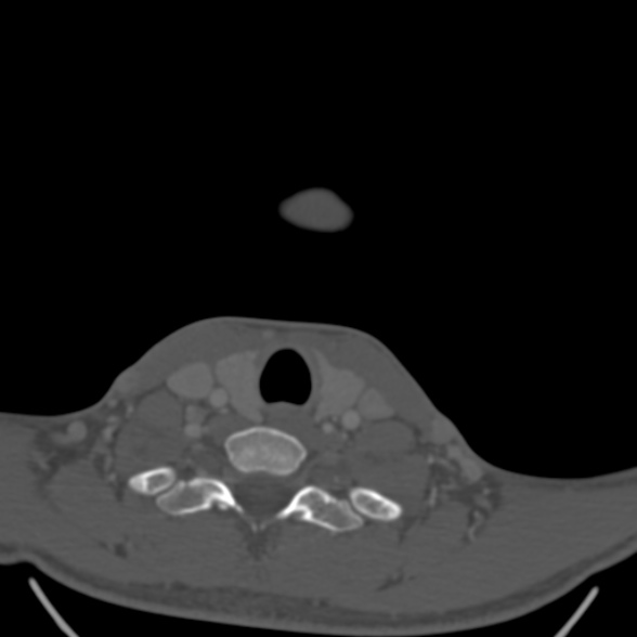 Nasopharyngeal carcinoma with skull base invasion (Radiopaedia 53415-59705 Axial bone window 173).jpg