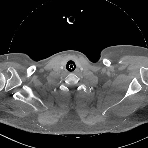 Neck CT angiogram (intraosseous vascular access) (Radiopaedia 55481-61945 B 126).jpg