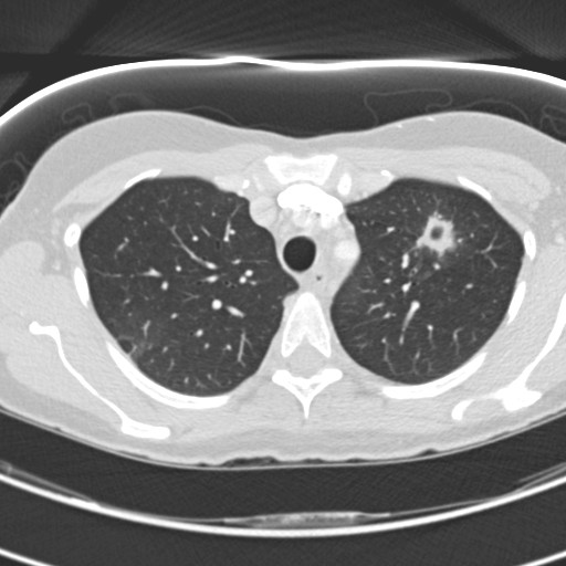 Necrobiotic pulmonary nodules - Crohn disease (Radiopaedia 20723-20631 Axial lung window 36).jpg