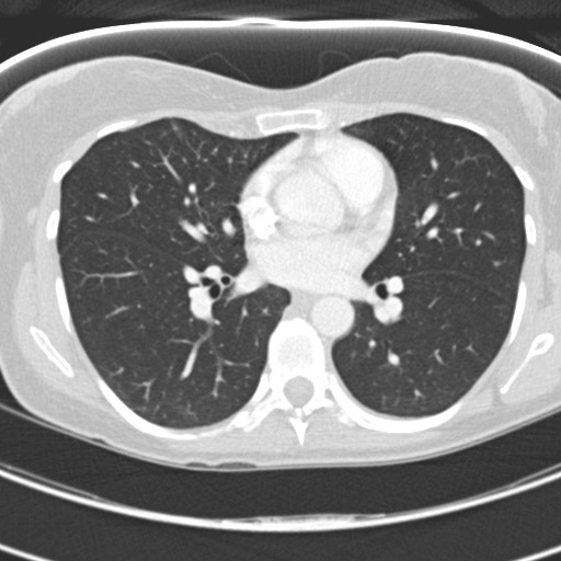 File:Necrobiotic pulmonary nodules - Crohn disease (Radiopaedia 20723-20631 Axial lung window 76).jpg