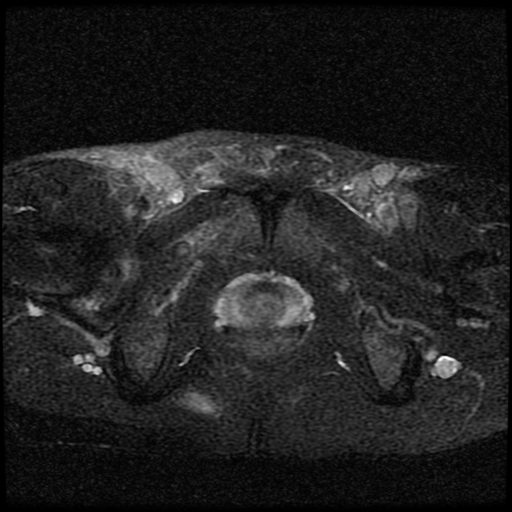 File:Necrotizing epididymo-orchitis with intra-testicular abscess (Radiopaedia 29397-29860 Axial T2 fat sat 5).jpg