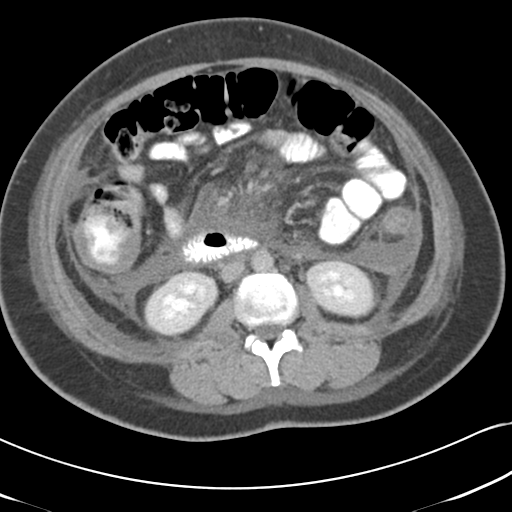 Necrotizing pancreatitis (Radiopaedia 50998-56540 A 40).png