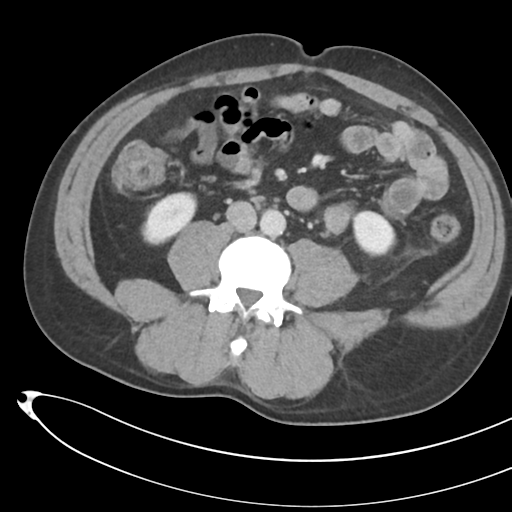 File:Necrotizing pancreatitis with acute necrotic collections (Radiopaedia 38829-41012 B 47).png