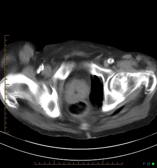 Necrotzing fasciitis due to a perforated adenocarcinoma of the splenic flexure (Radiopaedia 46930-51455 A 62).jpg