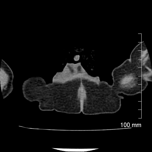 File:Neonatal neuroblastoma (Radiopaedia 56651-63438 Axial non-contrast 96).jpg