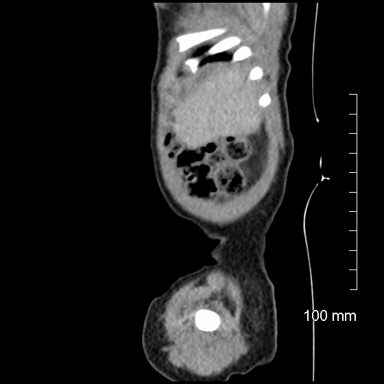File:Neonatal neuroblastoma (Radiopaedia 56651-63438 C 17).jpg