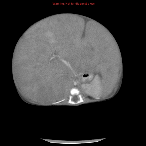 File:Neonatal neuroblastoma (Radiopaedia 9564-10223 A 24).jpg