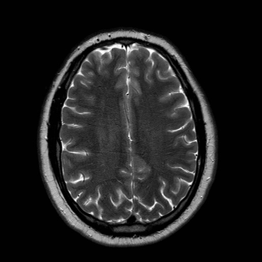 File:Neuro-Behcet's disease (Radiopaedia 21557-21506 Axial T2 19).jpg