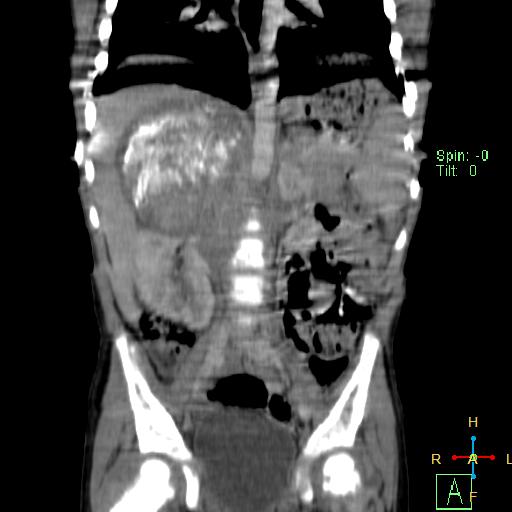File:Neuroblastoma (Radiopaedia 24751-25016 B 15).jpg