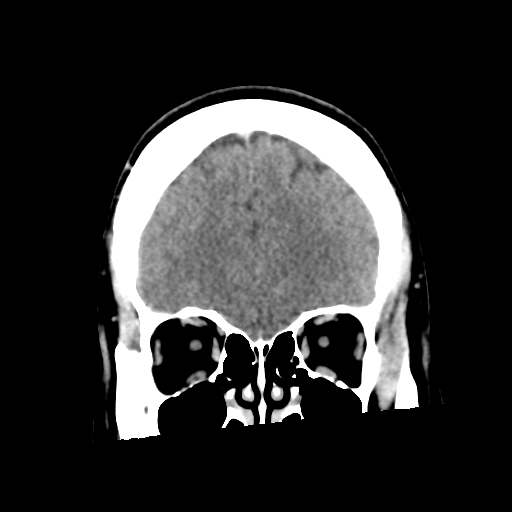 Neurocysticercosis - granular nodular (Radiopaedia 42786-45957 Coronal C+ 16).png