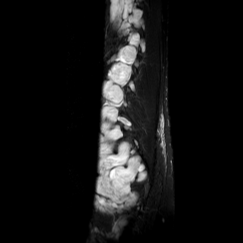 File:Neurofibromatosis type 1- extensive spinal involvement and Christmas tree sign (Radiopaedia 60610-68332 Sagittal STIR 3).jpg