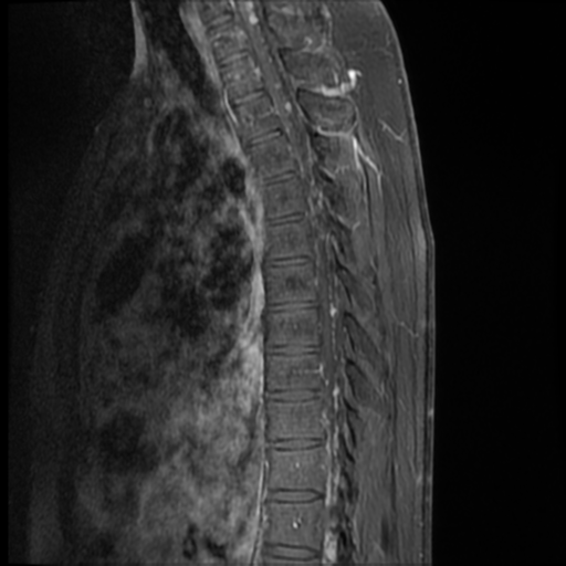 File:Neurofibromatosis type 2 (spinal manifestations) (Radiopaedia 53943-60070 I 6).png