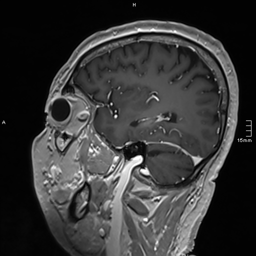 Neurosarcoidosis - involvement of the mesial temporal lobes (Radiopaedia 67429-76820 Sagittal T1 C+ 122).jpg