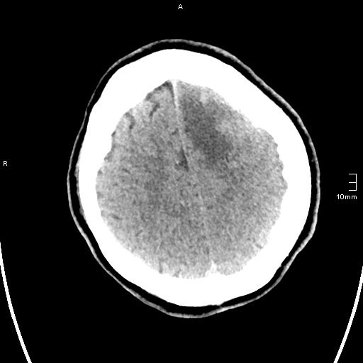 File:Neurotoxoplasmosis - concentric target sign (Radiopaedia 70644-80783 Axial non-contrast 31).jpg
