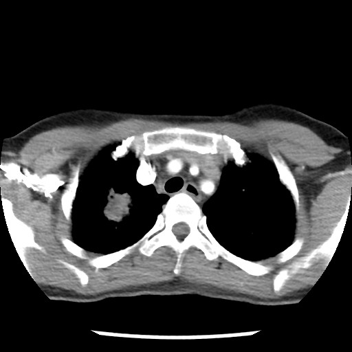 File:Non-small cell lung cancer with miliary metastases (Radiopaedia 23995-24193 A 13).jpg