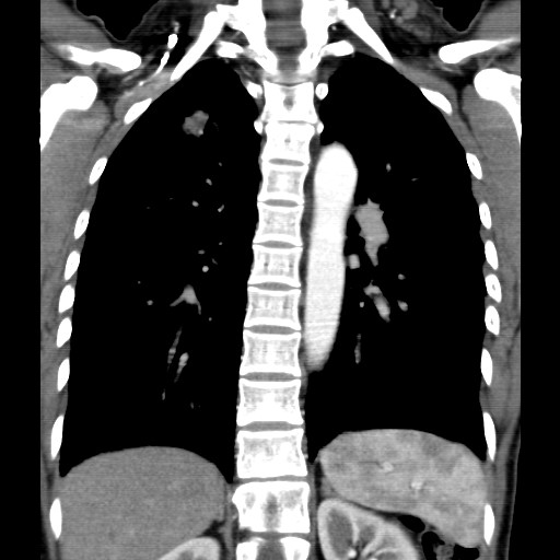 File:Non-small cell lung cancer with miliary metastases (Radiopaedia 23995-24193 B 14).jpg