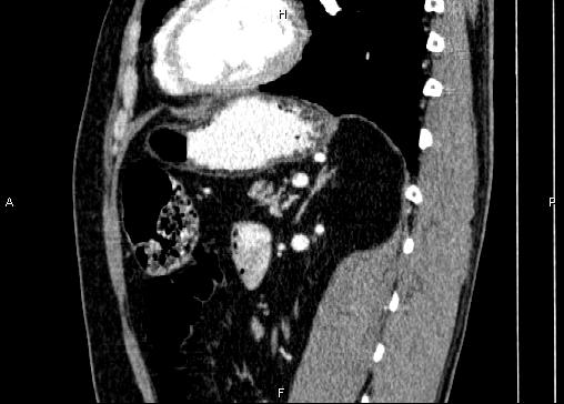 Non-syndromic pancreatic endocrine tumor (Radiopaedia 86958-103178 E 67).jpg