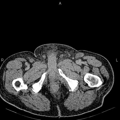 Non Hodgkin lymphoma in a patient with ankylosing spondylitis (Radiopaedia 84323-99621 Axial C+ delayed 92).jpg
