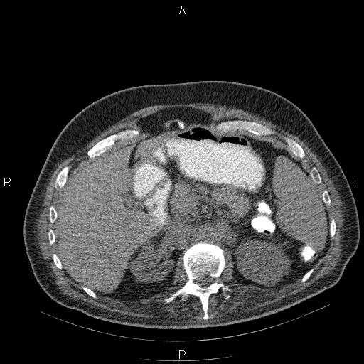 File:Non Hodgkin lymphoma in a patient with ankylosing spondylitis (Radiopaedia 84323-99624 Axial non-contrast 36).jpg