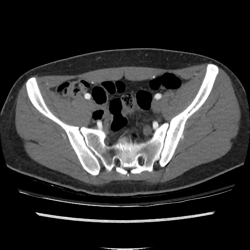 File:Normal CT angiogram of pelvis (Radiopaedia 45390-49430 A 32).jpg