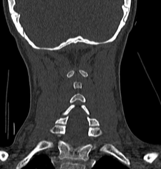 File:Normal CT cervical spine - 12-year-old (Radiopaedia 55352-61775 Coronal bone window 160).jpg