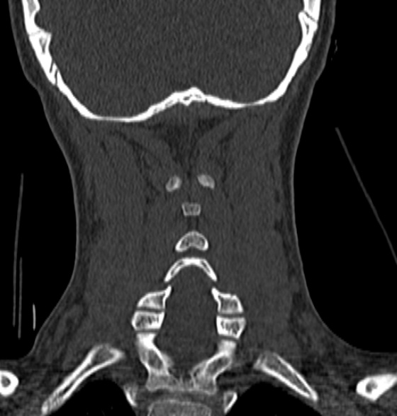 File:Normal CT cervical spine - 12-year-old (Radiopaedia 55352-61775 Coronal bone window 164).jpg