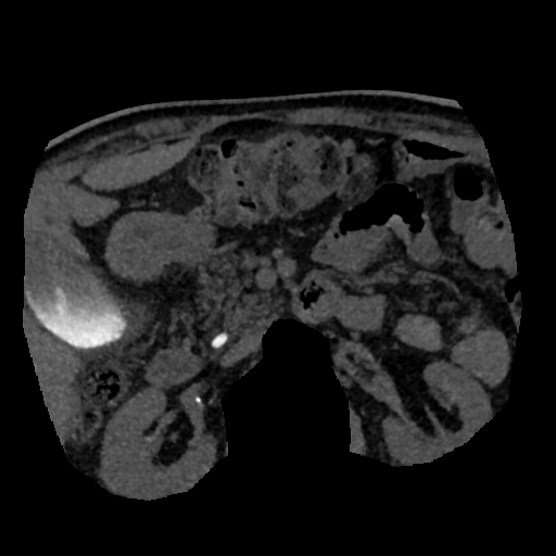 File:Normal CT intravenous cholangiogram (Radiopaedia 38199-40208 Axial IVC (MIP) 23).png