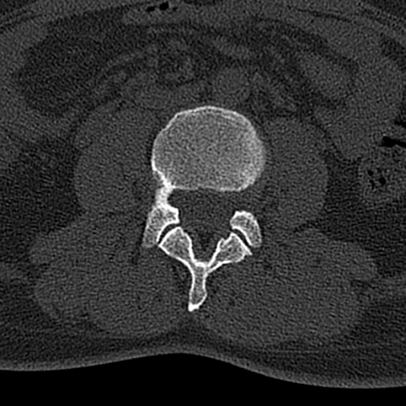 File:Normal CT lumbar spine (Radiopaedia 53981-60118 Axial bone window 42).jpg