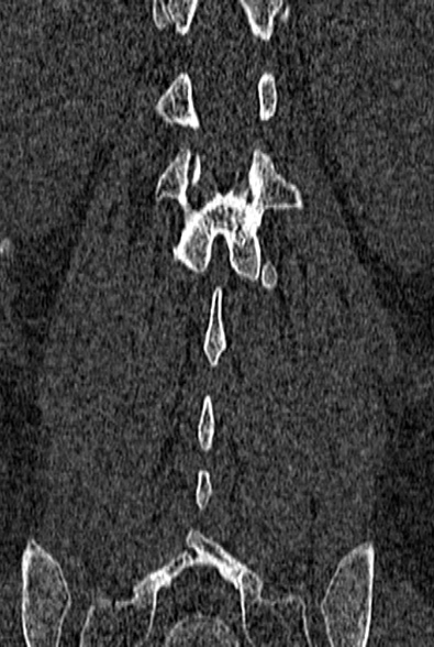 Normal CT lumbar spine (Radiopaedia 53981-60118 Coronal bone window 54).jpg