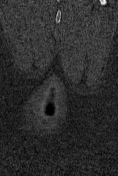 Normal CT lumbar spine (Radiopaedia 53981-60118 Coronal bone window 79).jpg