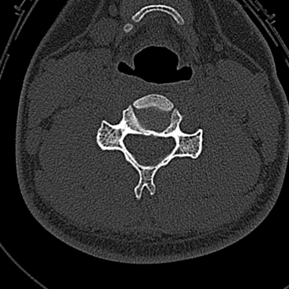 File:Normal CT of the cervical spine (Radiopaedia 53322-59305 Axial bone window 150).jpg
