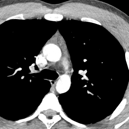 File:Normal CT pulmonary veins (pre RF ablation) (Radiopaedia 41748-44702 A 32).png